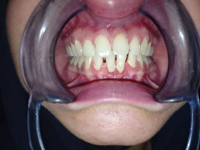 Dental Treatment Result Karachi