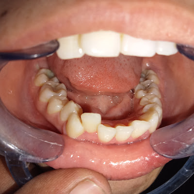 Dental Treatment Result Karachi