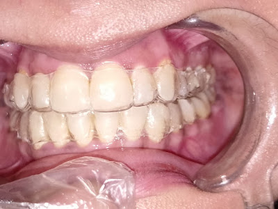 Dental Treatment Result Karachi