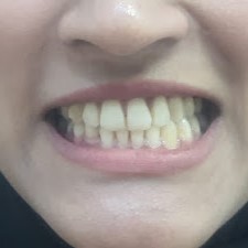 Dental Treatment Result Karachi