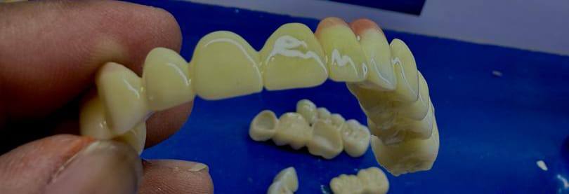 iSmile Aligner Treatment Before After Karachi