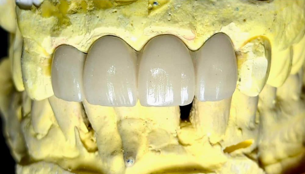 Dental Aligners Treatment Karachi